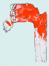 Figure 1: Sudan-stained aorta of a rabbit fed 61 egg yolks over a 70-day period, showing lesions in red.